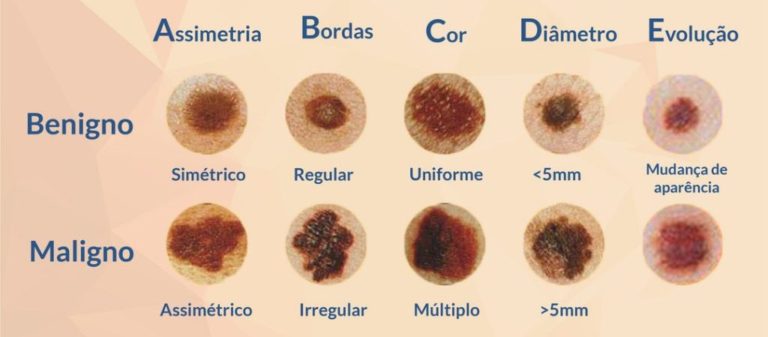 ABCDE das pintas: aprenda a identificar risco de câncer de pele