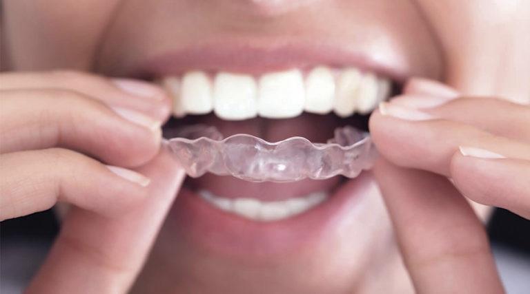 Cinco motivos para alinhar os dentes e sorrir para as fotos