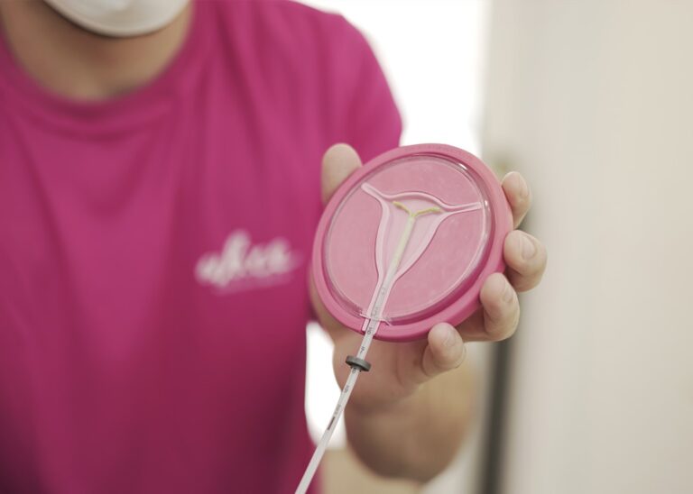 Uso do DIU é uma alternativa confiável para a contracepção e pode trazer outros benefícios