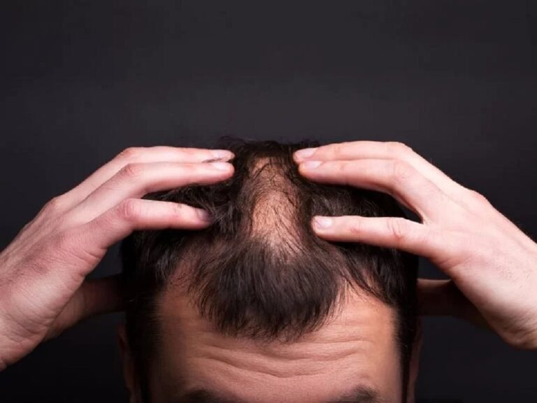 Especialista dá dicas e revela possíveis tratamentos para combater queda de cabelo