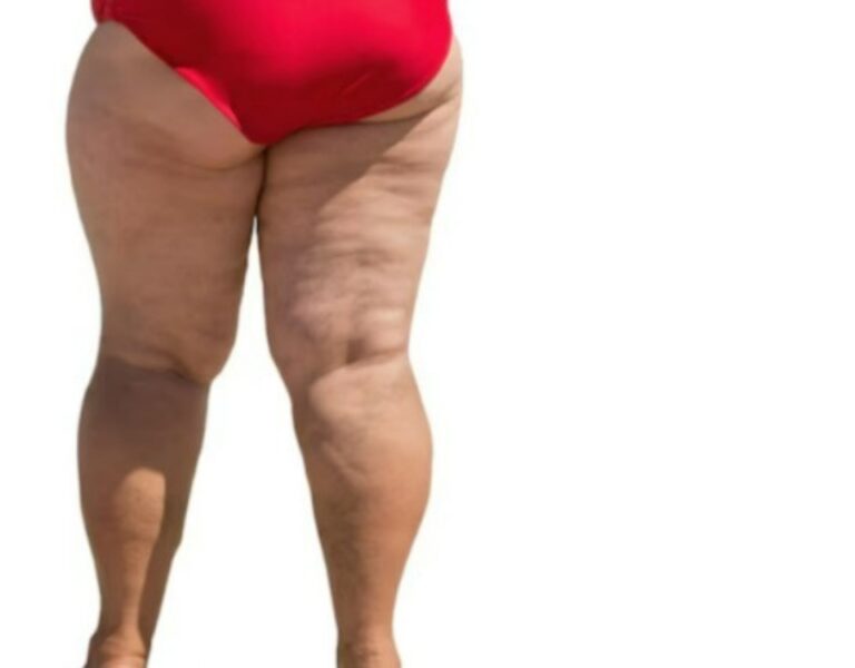 Lipoaspiração como tratamento para lipedema: cirurgia pode melhorar qualidade de vida das pacientes
