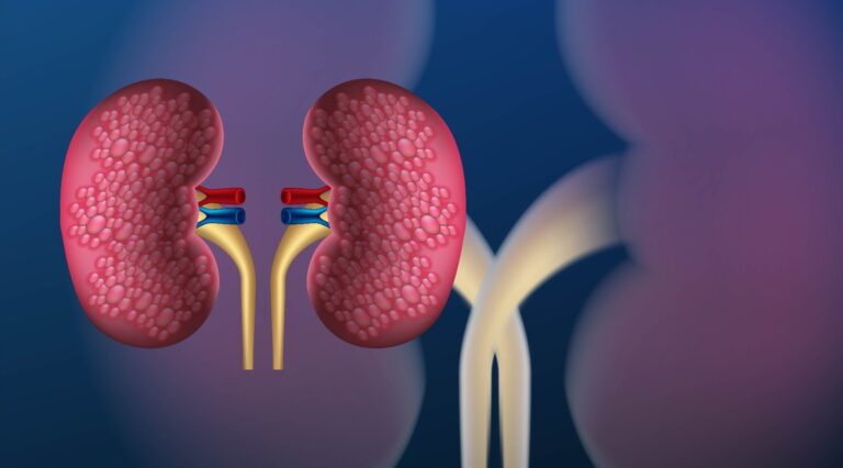 Urologista explica como identificar e prevenir o cálculo renal