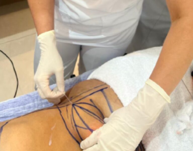 Mitos e verdades sobre a flacidez: o que realmente funciona?