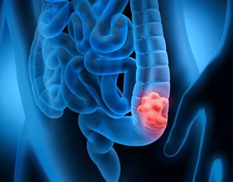 Março azul alerta para o crescimento de casos de câncer de intestino