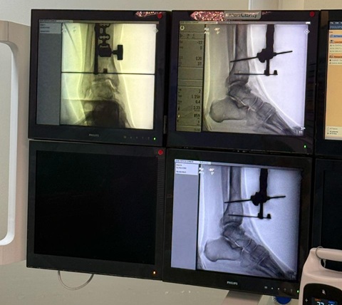 Hospital Mater Dei Santa Genoveva realiza primeira artroplastia de tornozelo em Uberlândia