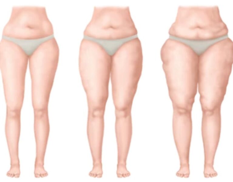 Lipedema: o que você precisa saber sobre essa doença