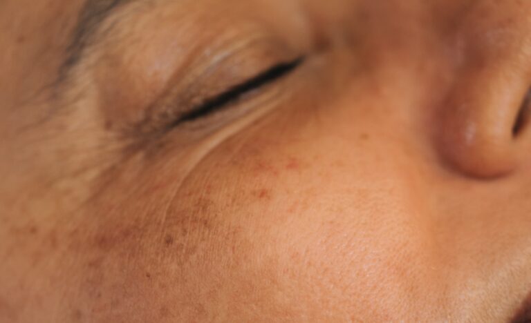 Manchas que vão além do espelho: o desafio das mulheres com Melasma